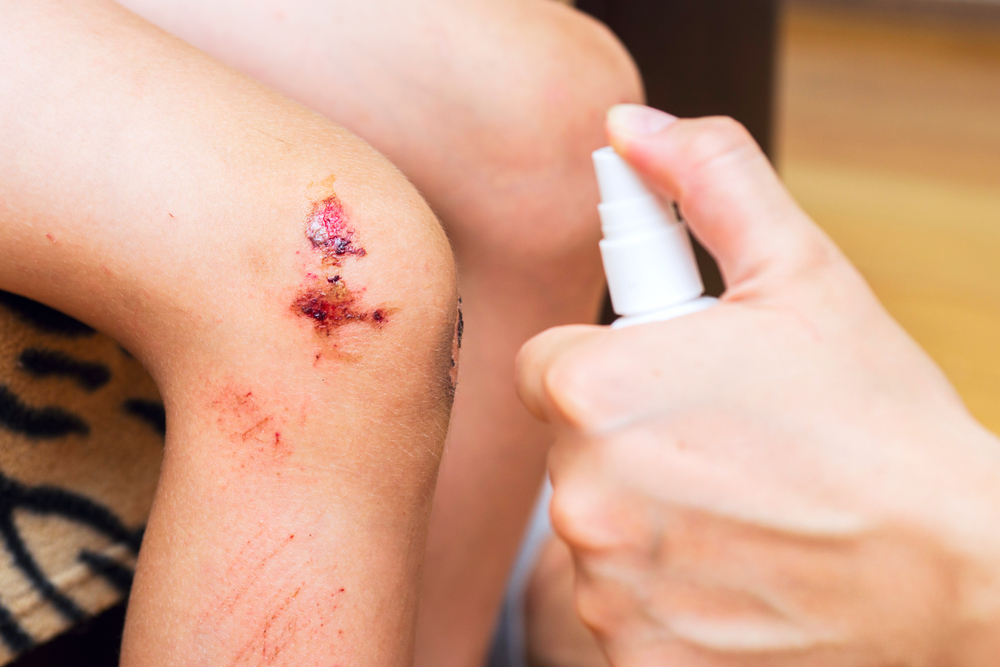 Odrgnjena kolena, oseba jih šprica z razkužilom